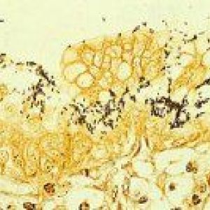 Helicobacter pylori
